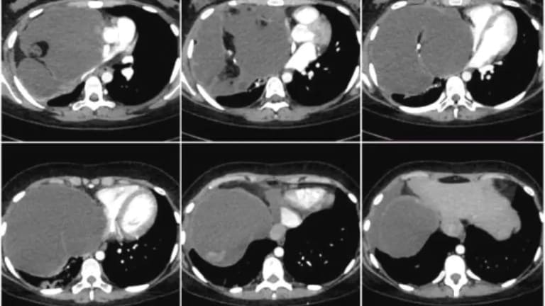 u máu trong gan có nguy hiểm không​